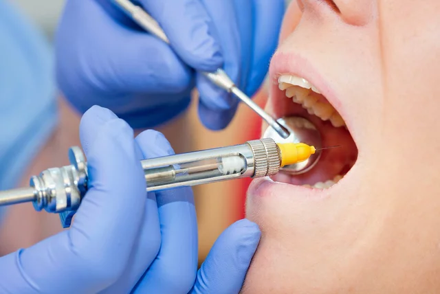 Los Beneficios de la Bemzocaína en Procedimientos Dentales