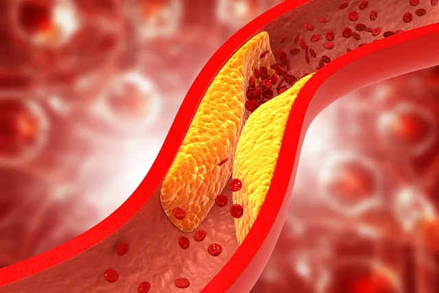 Manejo del colesterol alto con Atorvastatina